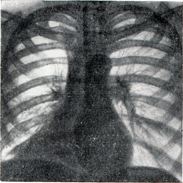 Ателектаз нижнего легкого. Ателектаз s1 правого лёгкого рентген. Тотальный ателектаз справа рентген. Тотальный ателектаз легкого. Ателектаз средней доли рентген.
