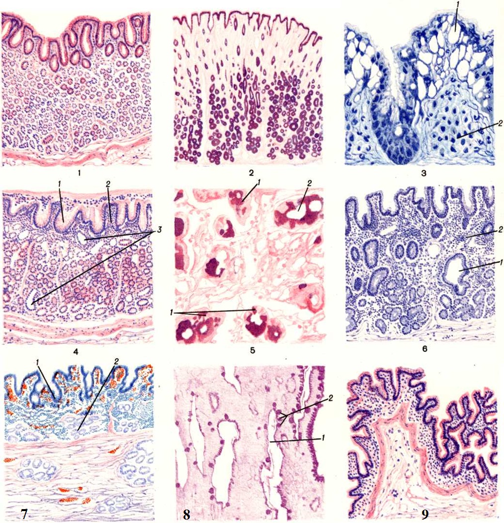 Регенерации слизистой оболочки. Хроническая язва желудка гистология. Острая язва желудка гистология. Атрофический колит гистология.