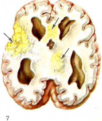 Туберкулез головного. Отогенный менингоэнцефалит. Туберкулезный менингит макропрепарат. Туберкулезный менингит патанатомия. Менингоэнцефалит макропрепарат.