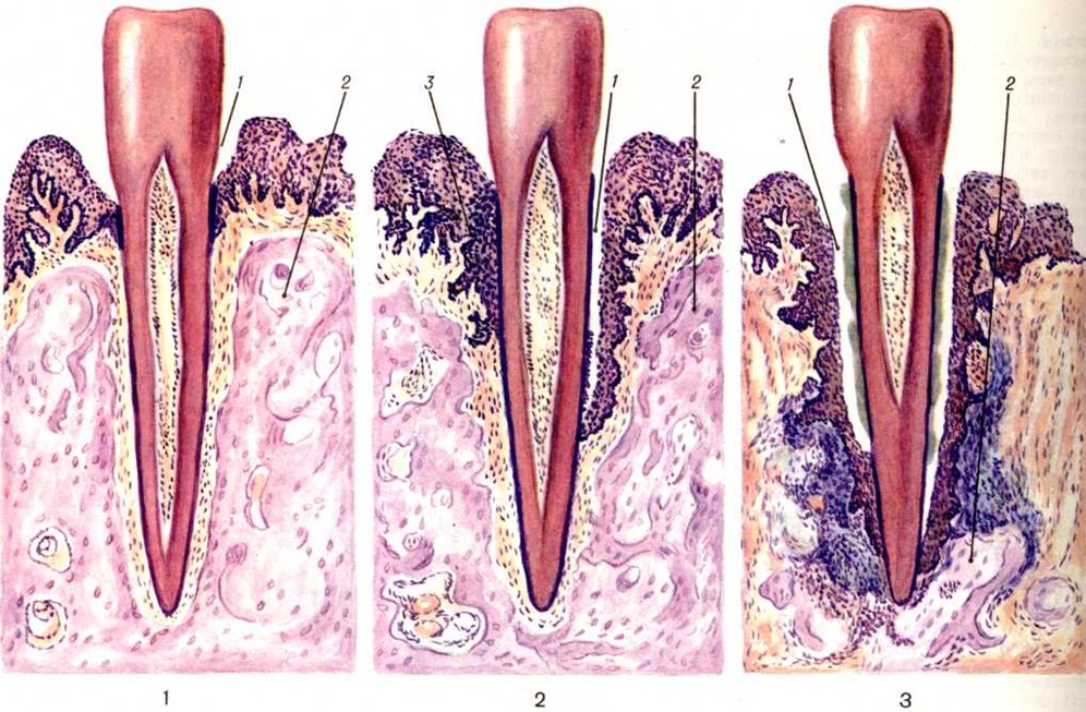 Сосуды десны. Гангренозный пародонтит. Пародонтит патанатомия. Пародонтоз патологическая анатомия.