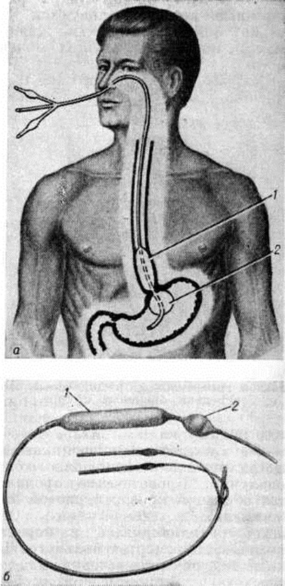 Слепой пищевод. Желудочный зонд назогастральный. Зондирование желудка через нос. Зонд для зондирование желудка. Назогастрального зонда в желудок.