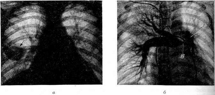 Тромбофлебит легочной артерии. Тромбоз легочной артерии 126.9 что такое. Тромбоэмболия легочной артерии рентген. Эмболия легочной артерии рентген.