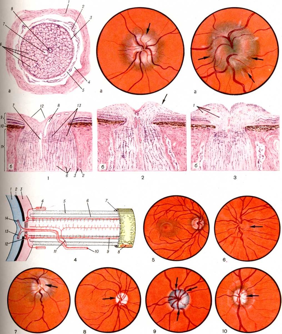 Сосудистые пучки это. Отечный диск зрительного нерва. Застойный сосочек зрительного нерва это. Деколорация диска зрительного нерва. Проминирует диск зрительного нерва.